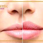 Dudak Kontürü Nedir Nasıl Yapılır?